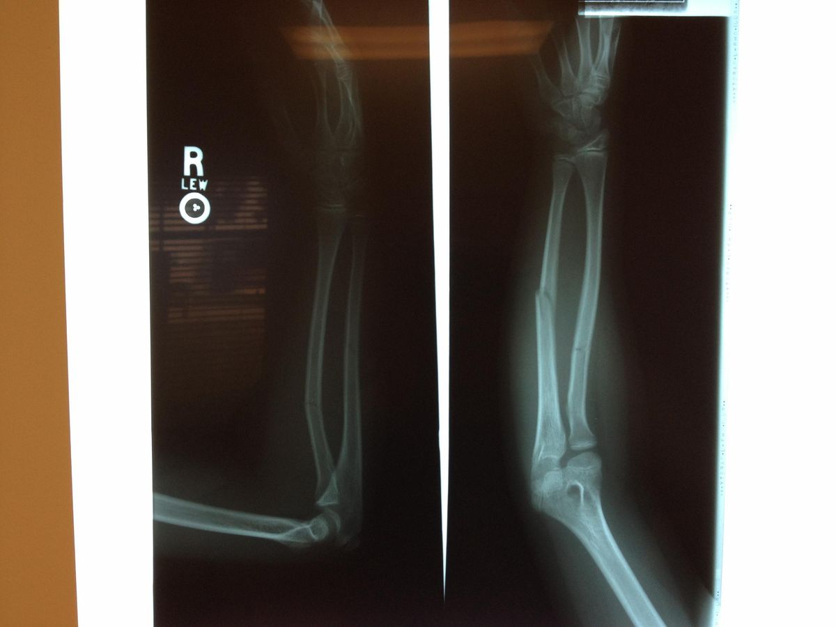 The Broken Arm In Pictures and Emails