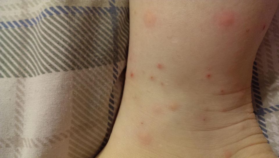 Chiggers and Things that Wiggle and Niggle and Gnaw